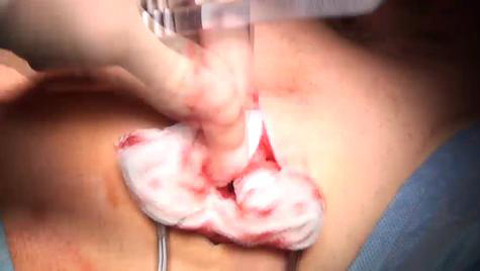 Live surgeries: Insertion of bulbar artifical sphincter - Suergeon: Miss Daniela Andrich