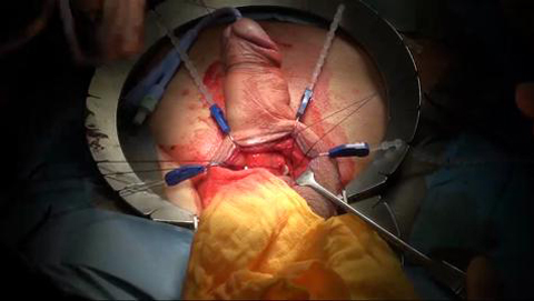 Live surgeries: Surgical Management of Penile Carcinoma