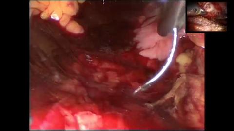 Prostatectomía robotizada. Promontofijacion laparoscópica + prótesis uretral - Dr. Lauren Hugo López y Dr. Richard Pierre Gaston