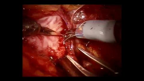 Prostatectomía robotizada + linfadenectomía | Nefrectomíaparcial izquierda robotizada