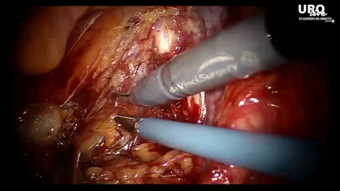 Cirugía Mínimamente Invasiva - Cistectomía radical robótica con derivación intracorporea mediante conducto ileal (0h00’- 2h00’) | Nefrectomía Parcial por Retroperitoneoscopia - Dr. Richard Pierre Gaston