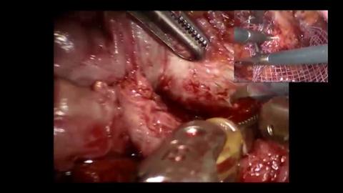 Prosectomía robotizada. Promontofijación laparoscópica - Dr. Denis Rey y Dr. Richard Pierre Gaston